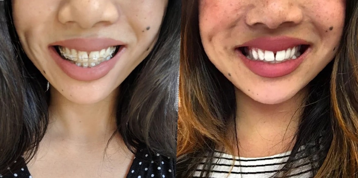 teeth-bonding-before-and-after-3