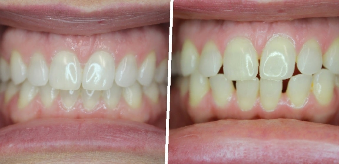 teeth-bonding-before-and-after-5