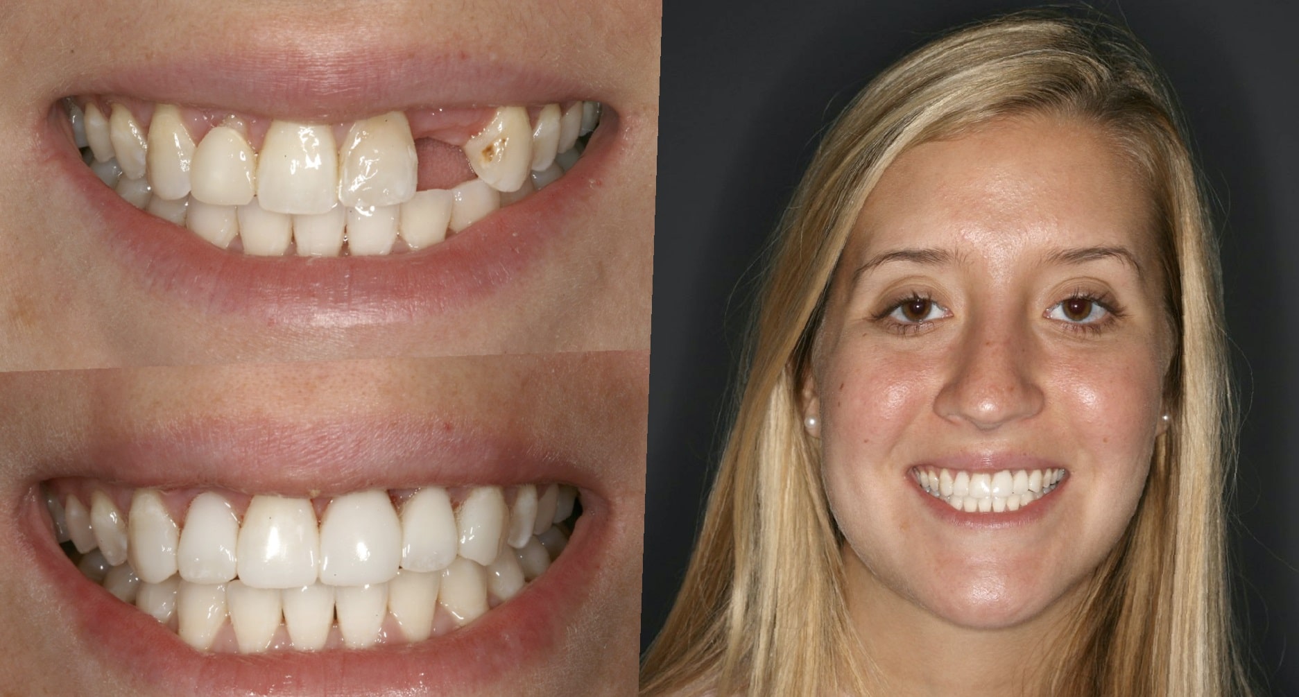 teeth-bonding-before-and-after-6