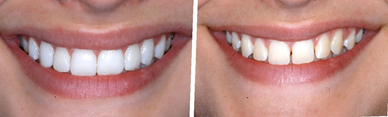 teeth-bonding-before-and-after-7