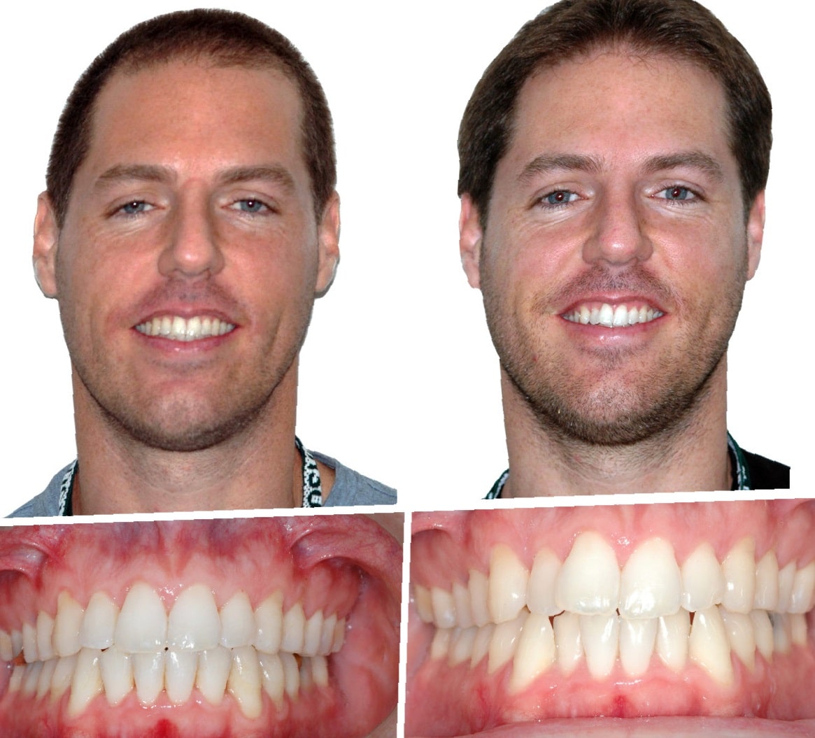 teeth-bonding-before-and-after-8